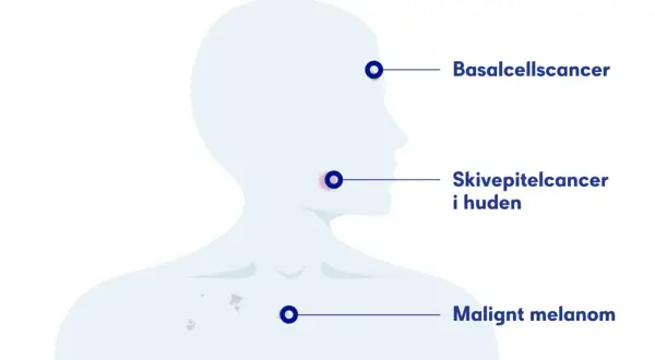 Illustration visar olika hudcancerformer: basalcellscancer, skivepitelcancer i huden och malignt melanom.