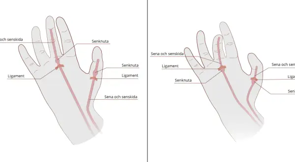 Illustration av senor, ligament och senknutor i handen. Kan visa var en kramp i fingrar kan uppstå.