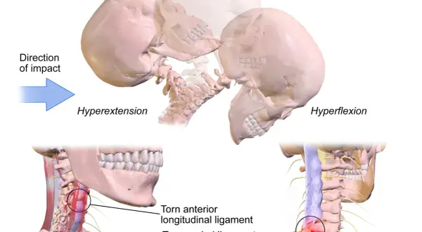 Illustration visar hur en bruten nacke symtom kan uppstå vid hyperextension och hyperflexion, med skadade ligament i nacken.