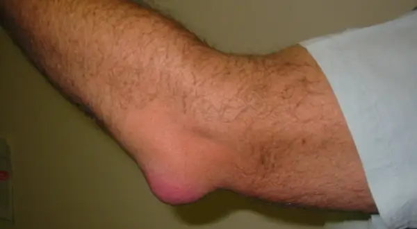 En arm med tydlig svullnad vid armbågen, troligen bursit armbåge.