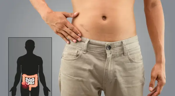 En illustration visar en mänsklig silhuett med tarmar, där ett område markerats med rött för att indikera mesenteriell lymfadenit. En person pekar på sitt eget magparti.