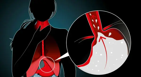 Illustration visar en person med halsbränna. En närbild visar magsyra som stiger upp i matstrupen, en möjlig indikation på att sluta med omeprazol biverkningar.