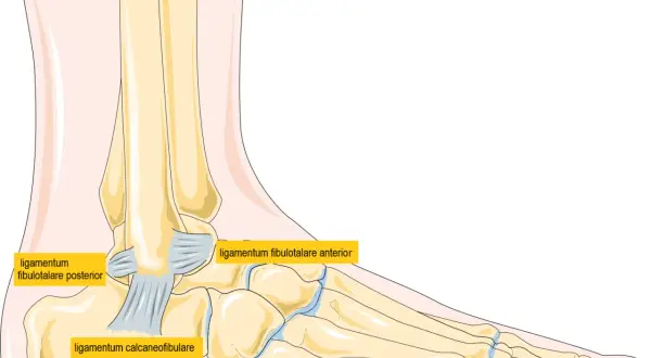 Illustration av fotens ben och ligament. Kan visa ett brutet ben i foten.