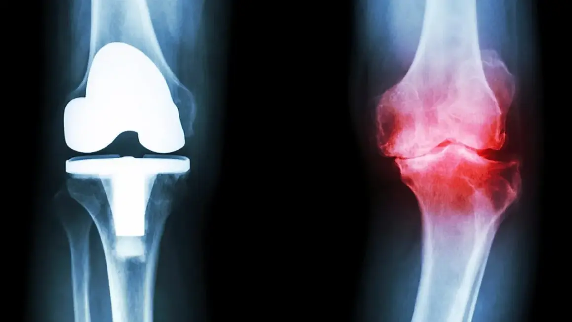 Röntgenbilder av knän: ett med protes, ett med inflammation. Frågan är hur lång tid tar det innan kortison verkar för att lindra smärtan.