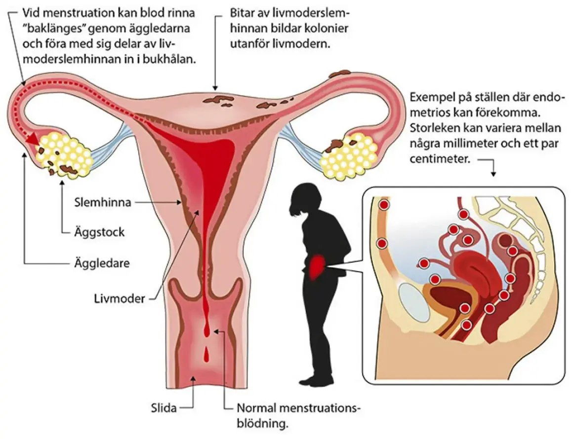 Illustration av livmodern och äggledare. Visar hur livmoderslemhinnan kan orsaka inflammation livmoder och endometrios.