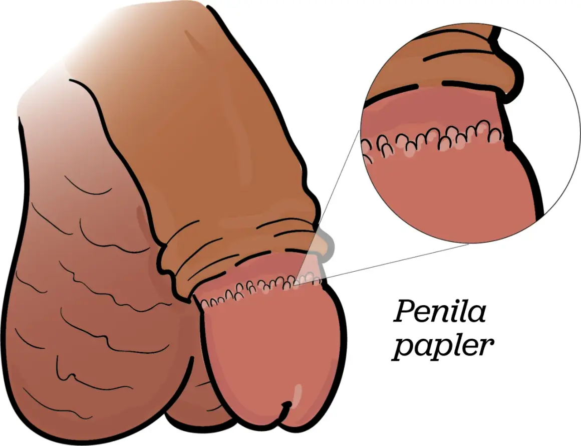 Illustration av en penis med en förstorad bild som visar prickar på ollonet, kallade penila papler.