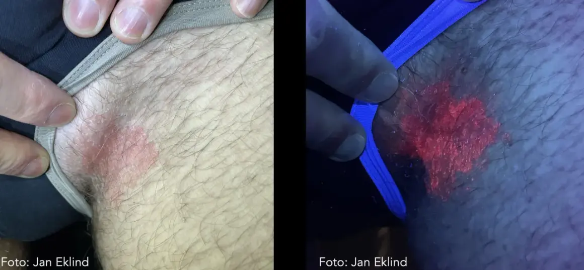 Hudutslag i ljumsken, synligt rött och fjällande. Under UV-ljus lyser utslaget starkt rött, vilket kan vara relaterat till klåda pungen diabetes.