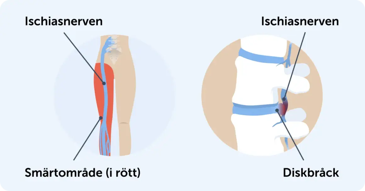 Illustration av ischiasnerven och diskbråck. Smärtområde i rött på benet.