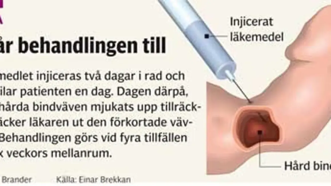 Illustration visar injektion av läkemedel för att behandla Peyronies sjukdom, mjukar upp hård bindväv.
