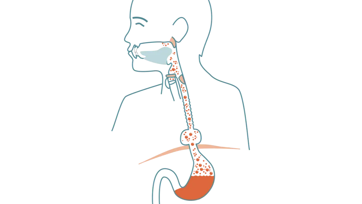 Illustration av matstrupen och magsäcken som visar reflux och potentiell risk för bråck på magmunnen cancer.