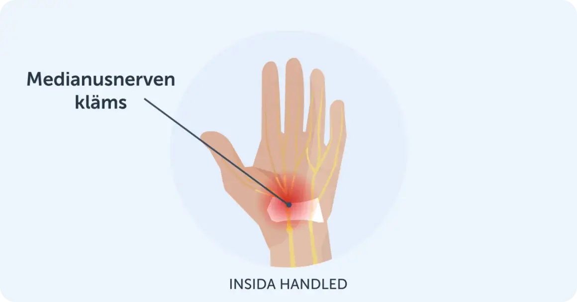 Illustration visar hur medianusnerven kläms i handleden, vilket kan orsaka karpaltunnelsyndrom och ont i tummen.