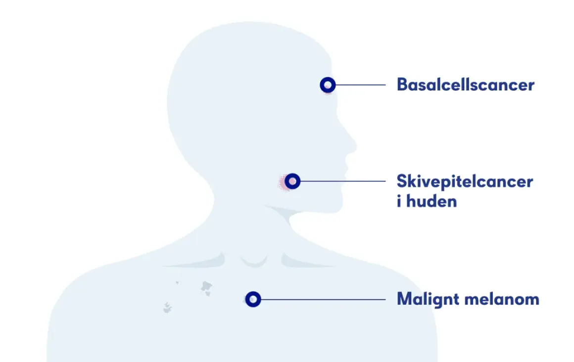 Illustration visar olika hudcancerformer: basalcellscancer, skivepitelcancer i huden och malignt melanom.