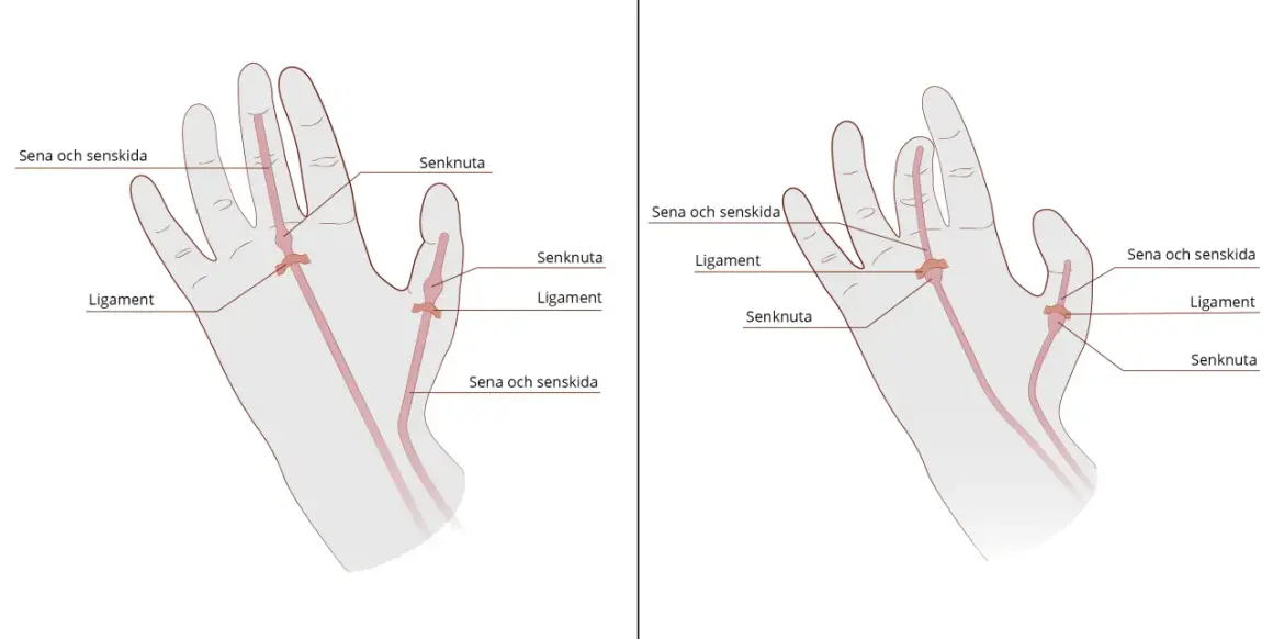 Illustration av senor, ligament och senknutor i handen. Kan visa var en kramp i fingrar kan uppstå.