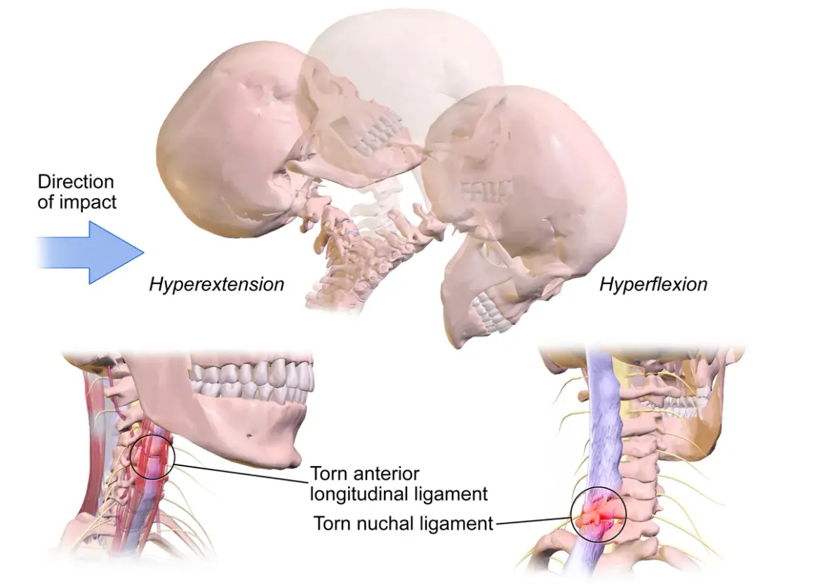 Illustration visar hur en bruten nacke symtom kan uppstå vid hyperextension och hyperflexion, med skadade ligament i nacken.
