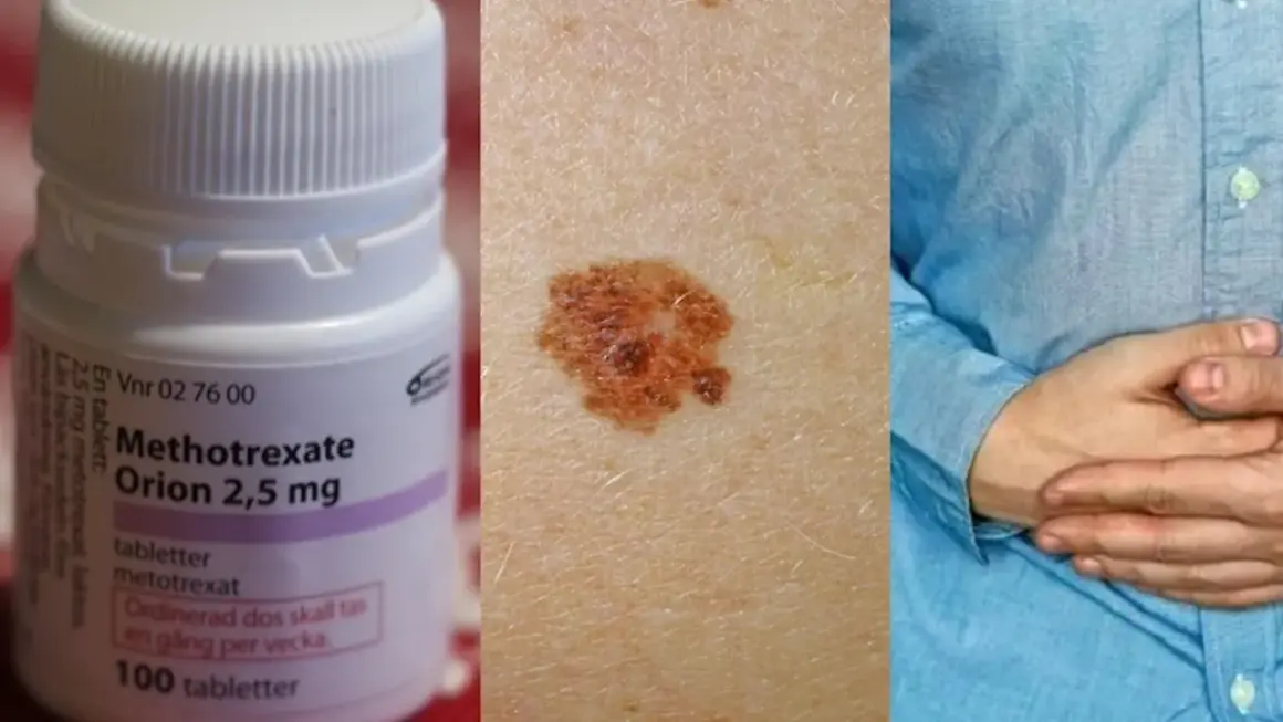 Metotrexat-flaska, hudförändring och person med magsmärtor. Viktigt att undvika alkohol vid behandling med metotrexat.