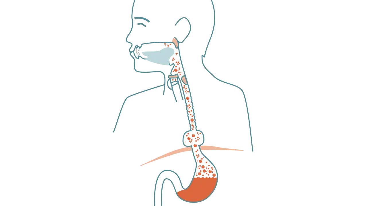 Är hiatusbråck cancer? Så hänger reflux och Barretts esofagus ihop