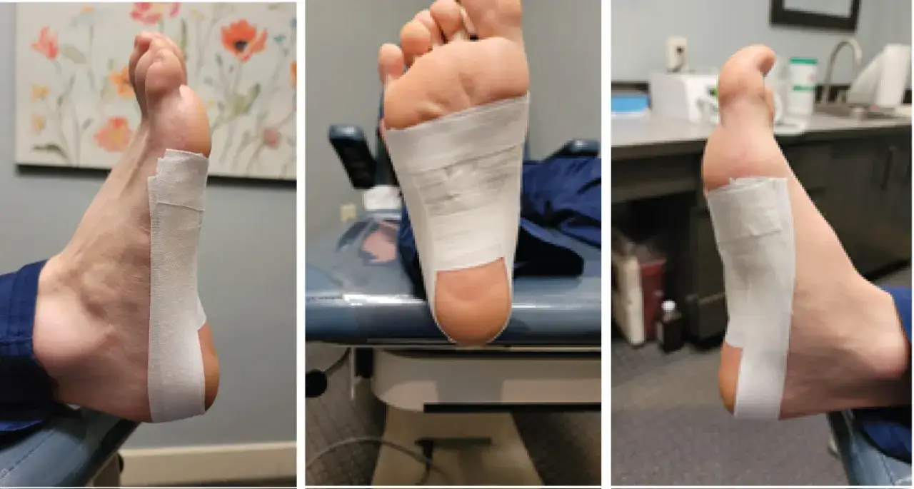 Tejpning av foten för att lindra smärta vid plantar fasciit. Tre bilder visar olika vinklar på tejpen som stöder fotvalvet och hälen.