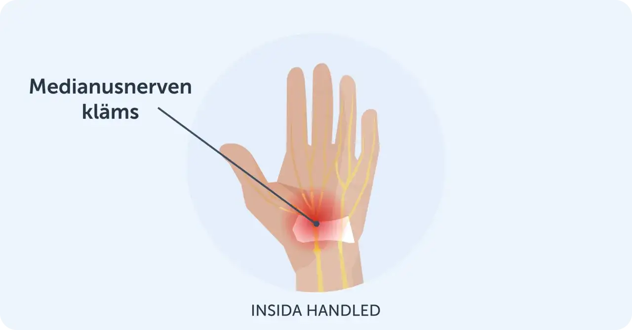 Illustration visar hur medianusnerven kläms i handleden, vilket kan orsaka karpaltunnelsyndrom och ont i tummen.