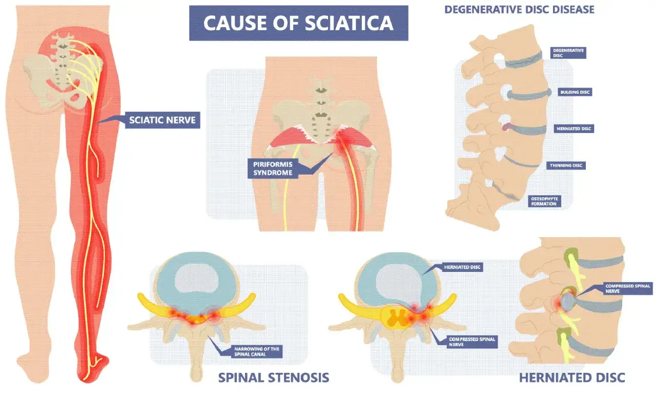 Illustration visar orsaker till ischias, inklusive piriformissyndrom, spinal stenos och diskbråck. L5 S1-området visas.