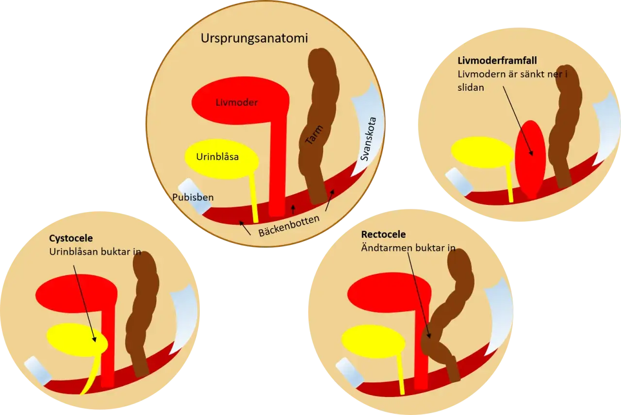 Illustrationer visar framfall symtom: livmoder, urinblåsa och tarm i bäckenet. Visar livmoderframfall, cystocele och rektosele.