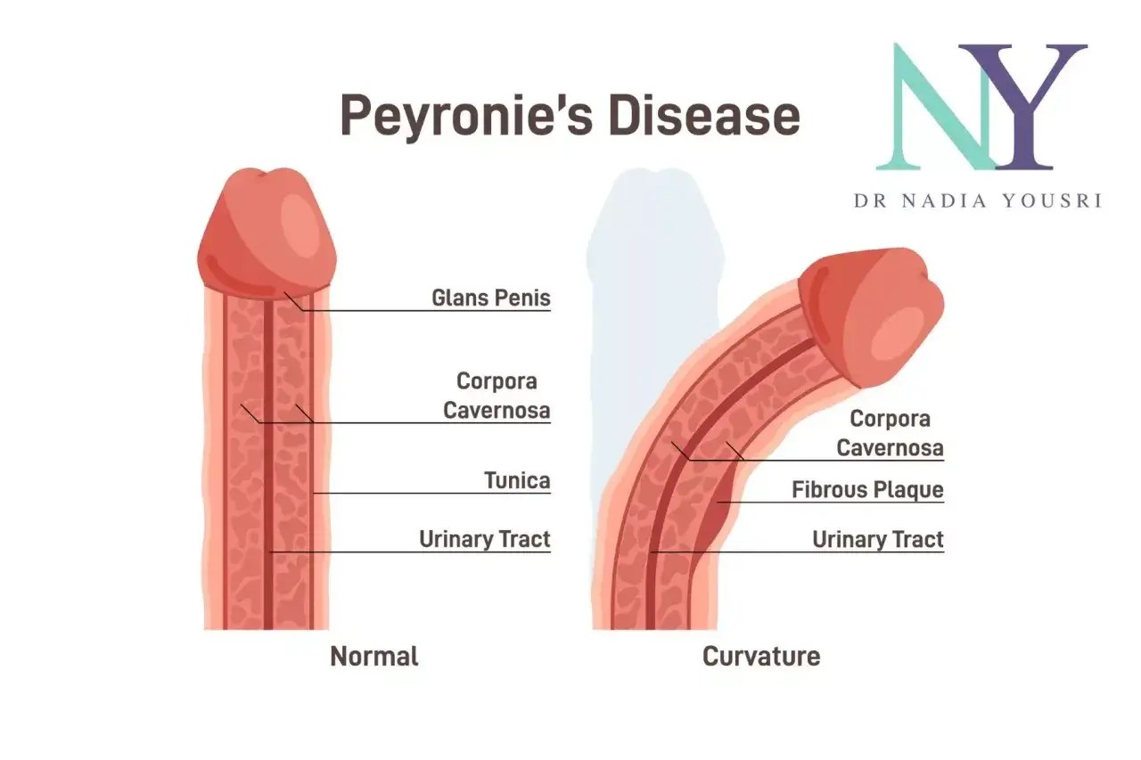 Illustration visar normal penis och penis med krökning orsakad av Peyronies sjukdom, med förklaring av anatomiska delar.