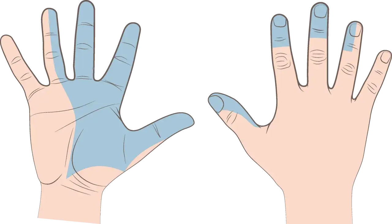 Illustration av händer som visar områden med domningar, potentiellt relaterat till diabetes.
