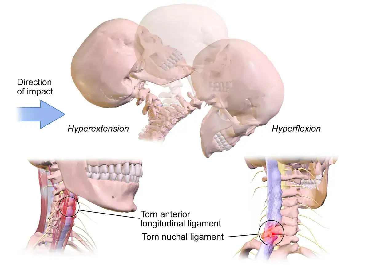 Illustration visar hur en bruten nacke symtom kan uppstå vid hyperextension och hyperflexion, med skadade ligament.