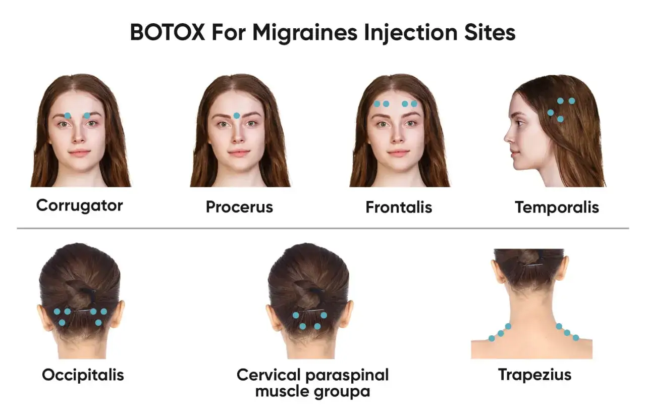 Visar injektionspunkter f&ouml;r spruta mot migr&auml;n i ansikte och nacke: Corrugator, Procerus, Frontalis, Temporalis, Occipitalis, Cervikal paraspinal muskelgrupp, Trapezius.