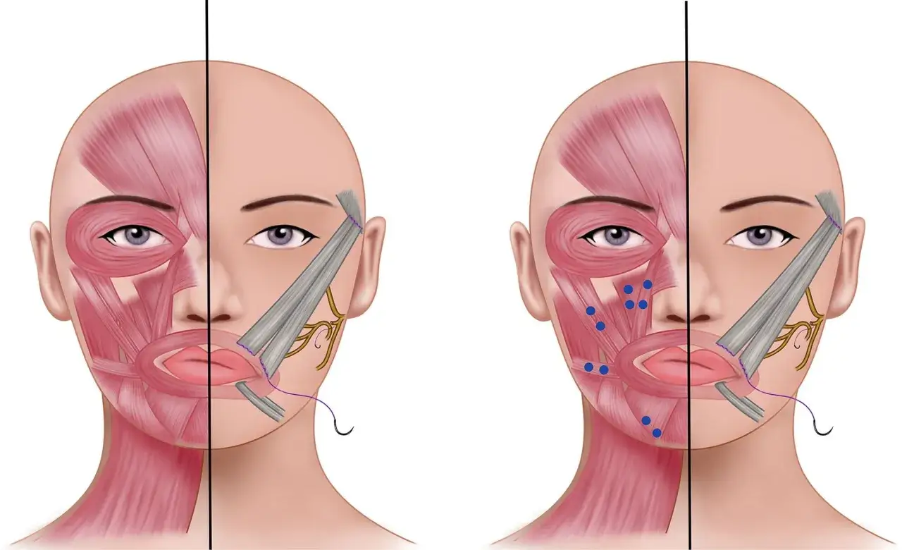 Illustration visar ansiktsmuskler, en sida med blå prickar som indikerar botulinumtoxin (botox) injektioner, den andra visar kirurgisk suturering.