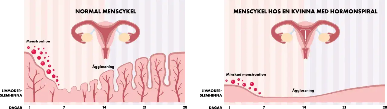 J&auml;mf&ouml;relse av normal menscykel med en med hormonspiral. Hormonspiral kan minska mens och PMS-besv&auml;r.