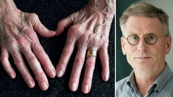 Behandling vid reumatoid artrit som skyddar lederna