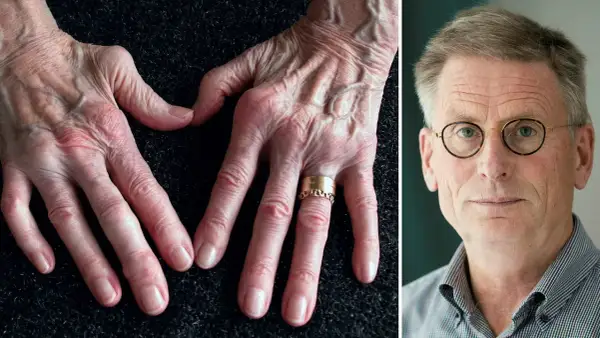 Händer med synliga ådror och knogar, en symbol för kampen mot ledgångsreumatism. Till höger en man med glasögon.