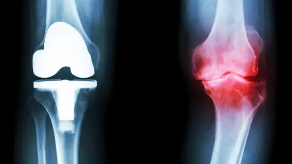 Röntgenbilder av knän: ett med protes, ett med inflammation. Frågan är hur lång tid tar det innan kortison verkar för att lindra smärtan.