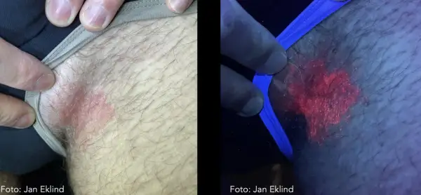 Hudutslag i ljumsken, synligt rött och fjällande. Under UV-ljus lyser utslaget starkt rött, vilket kan vara relaterat till klåda pungen diabetes.