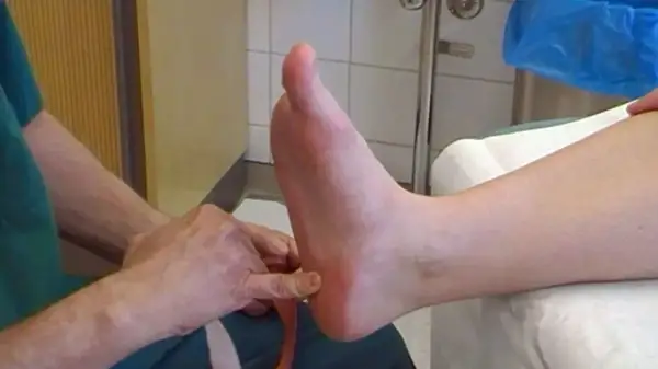 Här tejpas plantar fasciit med kinesiotejp för smärtlindring.