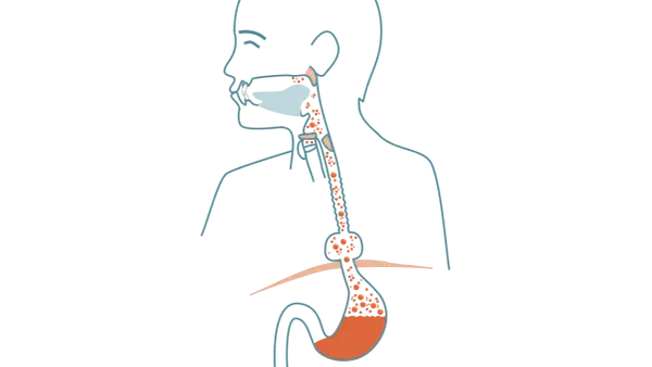 Illustration av matstrupen och magsäcken som visar reflux och potentiell risk för bråck på magmunnen cancer.