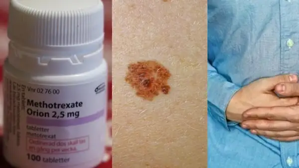 Metotrexat-flaska, hudförändring och person med magsmärtor. Viktigt att undvika alkohol vid behandling med metotrexat.